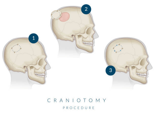 Brain Tumor Surgery in Hyderabad