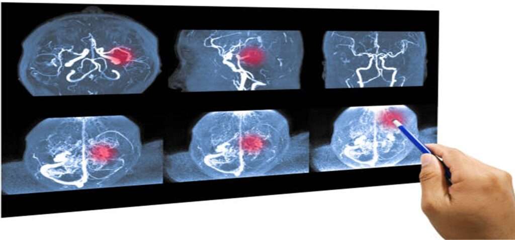 Brain Aneurysm Diagnosis 