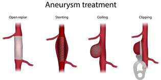 Brain Aneurysm Treatment