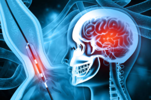 Interventional Neuroradiology