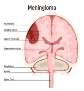 Meningioma