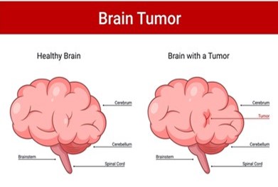 Brain Tumor