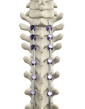 Spinal-fusion