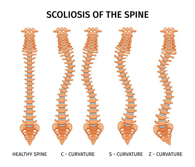 scoliosis-of-the-spine