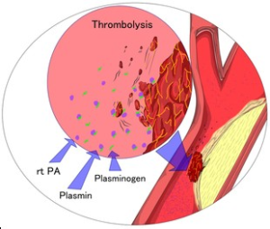 Intra-arterial Thrombolysis