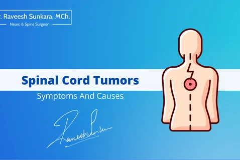 What Are Spinal Cord Tumors: Symptoms And Causes What Are Spinal Cord Tumors: Symptoms And Causes