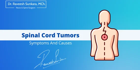 What Are Spinal Cord Tumors: Symptoms And Causes What Are Spinal Cord Tumors: Symptoms And Causes