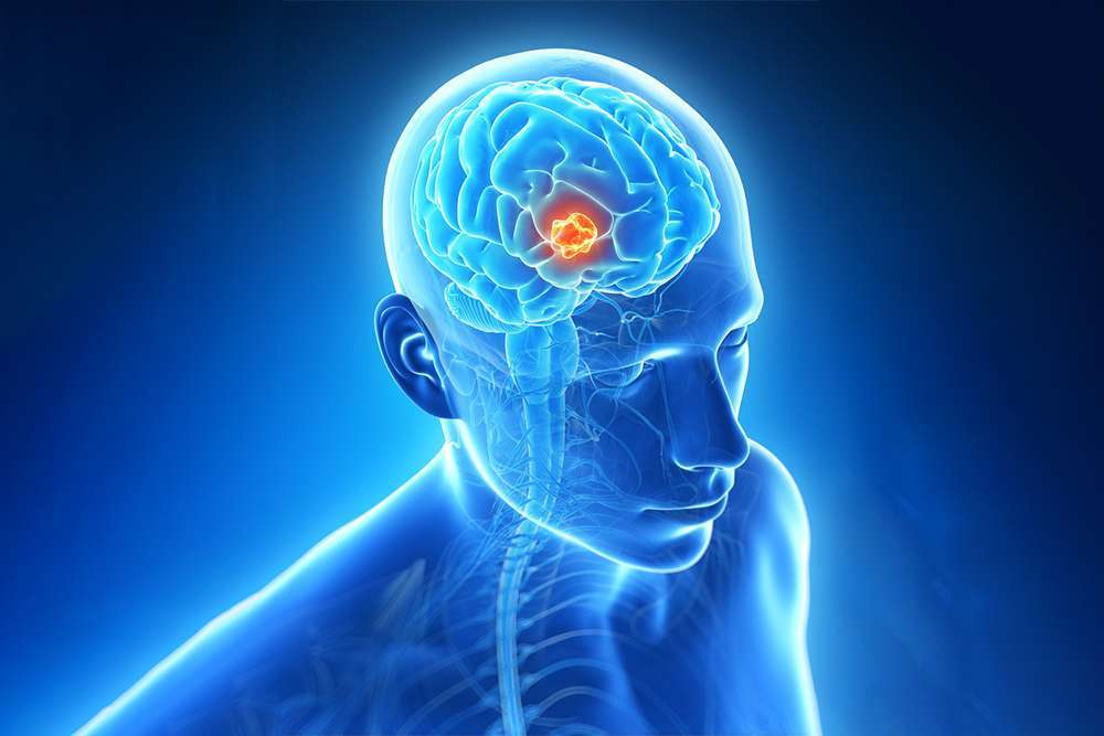 Neurology Services By Dr Raveesh Sunkara Hyderabad 3934