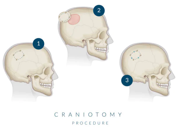 Brain Tumor Surgery in Hyderabad