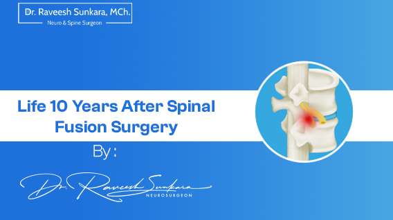 life-10-years-after-spinal-fusion-surgery-dr-raveesh-sunkara