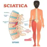 Sciatica