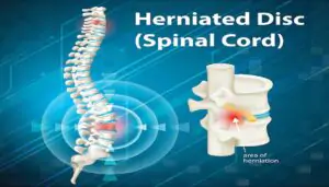 Herniated Disc