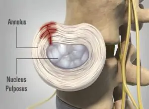 Facet Joint Disease