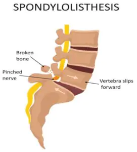 Spondylolisthesis