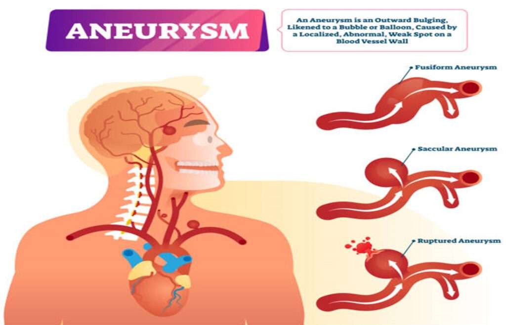 Brain Aneurysm Specialist In Hyderabad Dr Raveesh Sunkara 5719