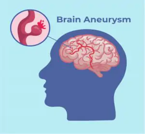 Risk Factors and Causes of Brain Aneurysm