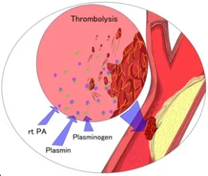 Intra-arterial Thrombolysis