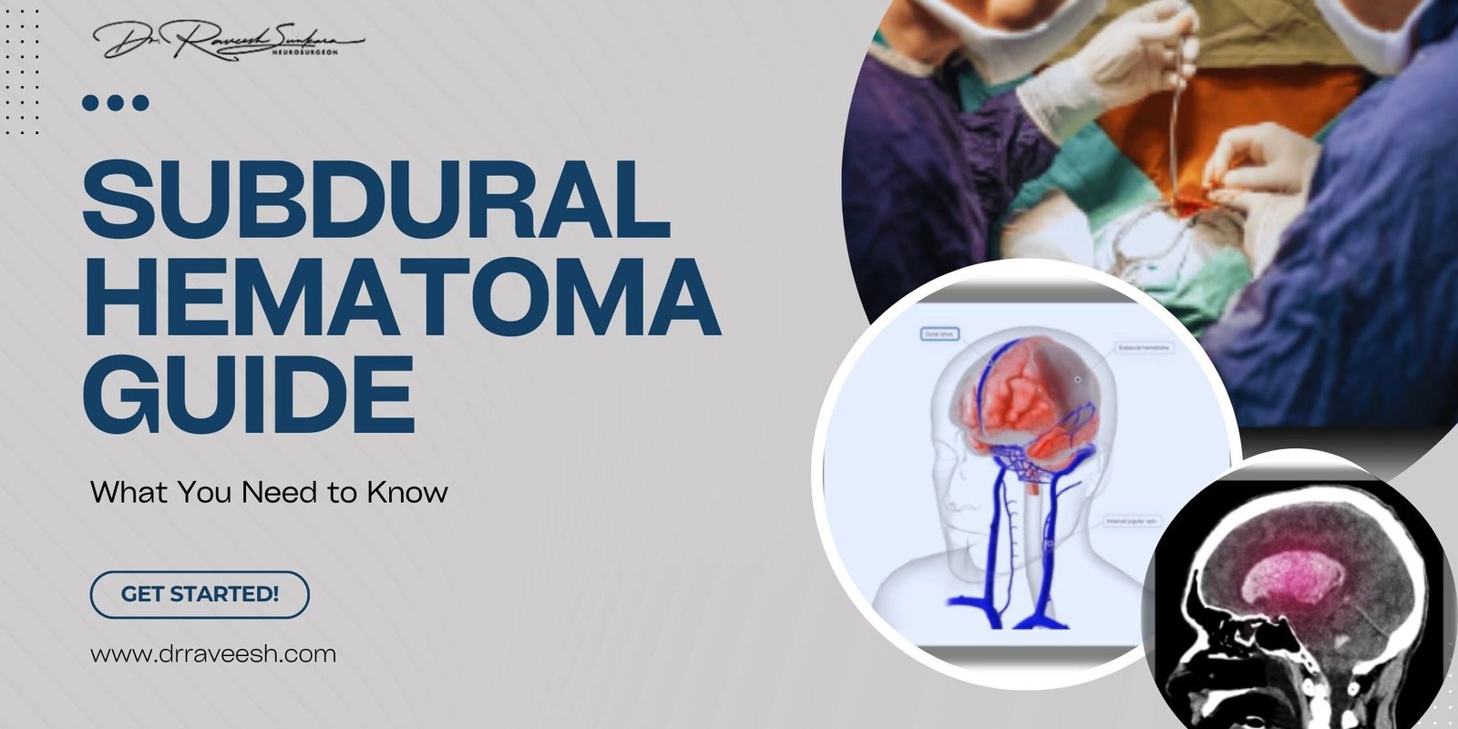 Subdural Hematoma Subdural Hematoma