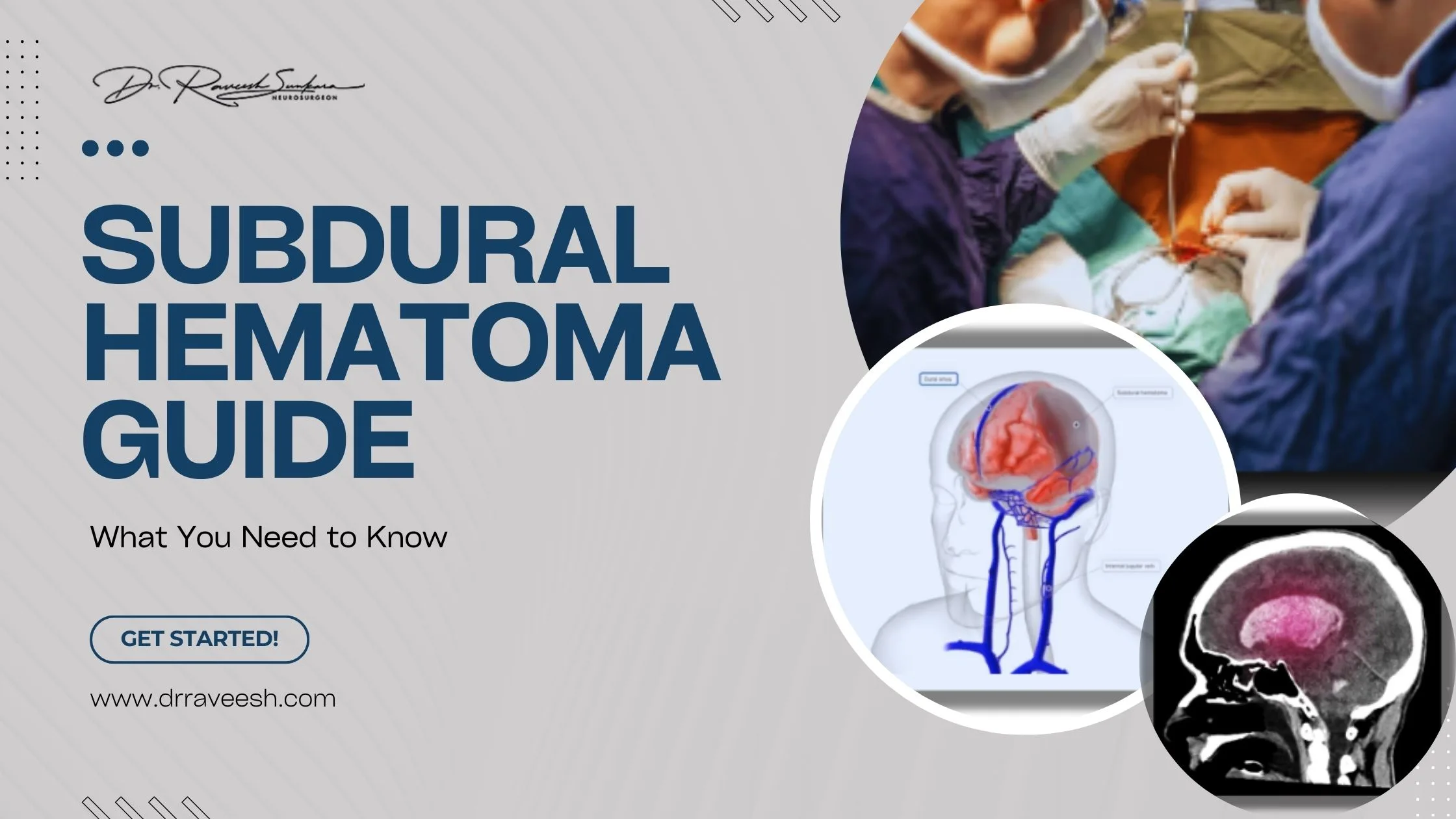 Subdural Hematoma
