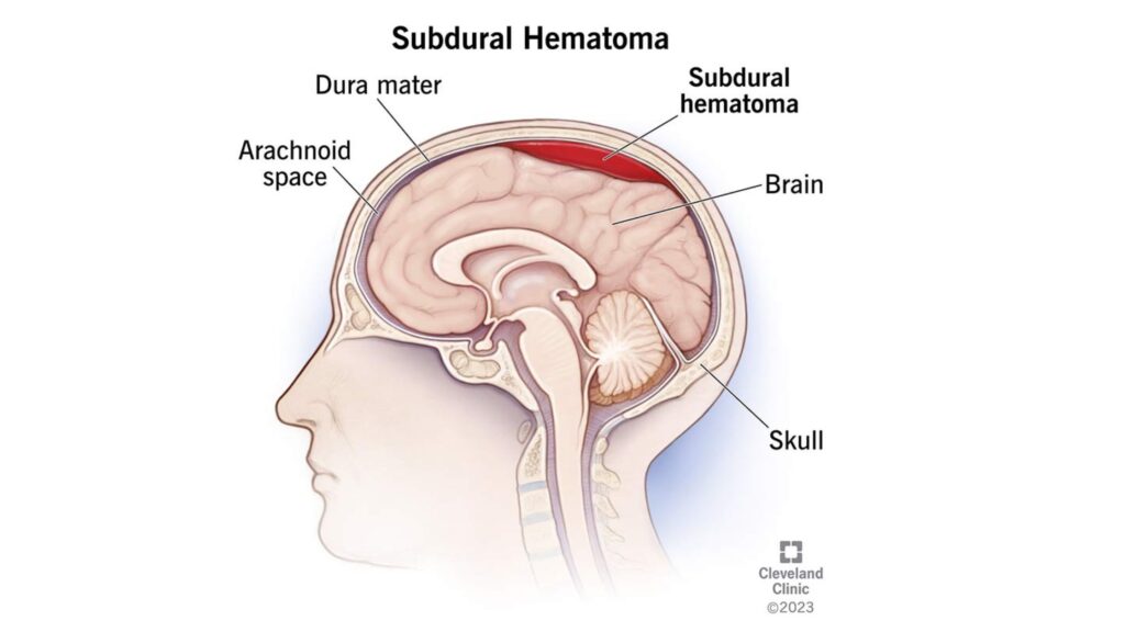 Subdural Hematomas