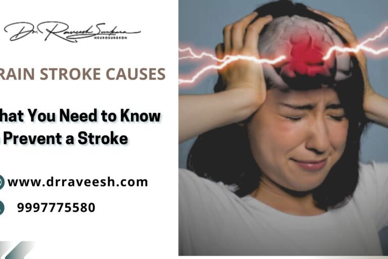 Brain Stroke Causes Brain Stroke Causes