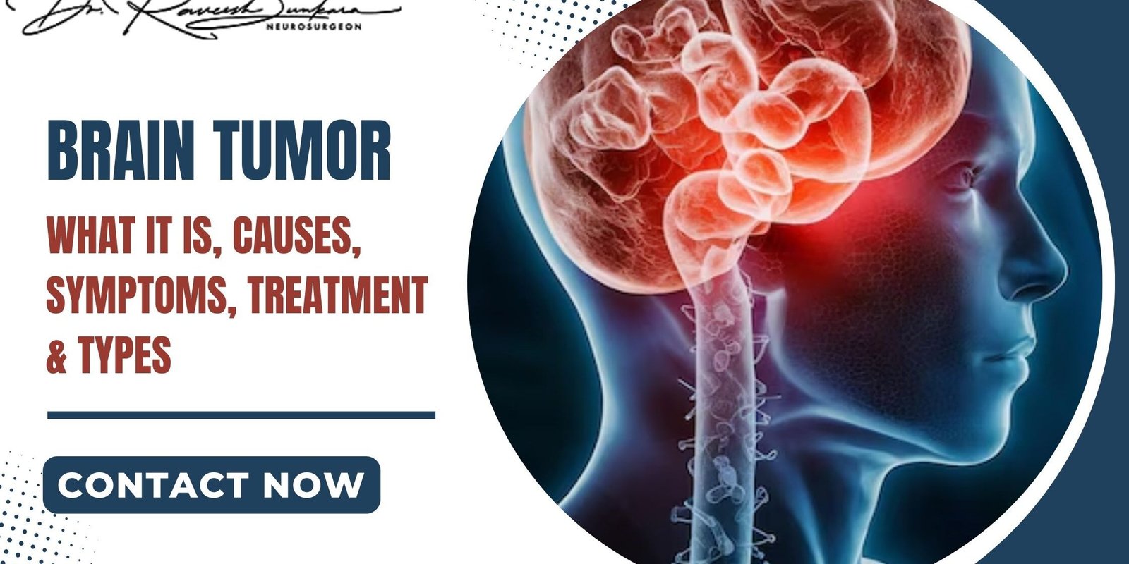 Brain Tumors Brain Tumors