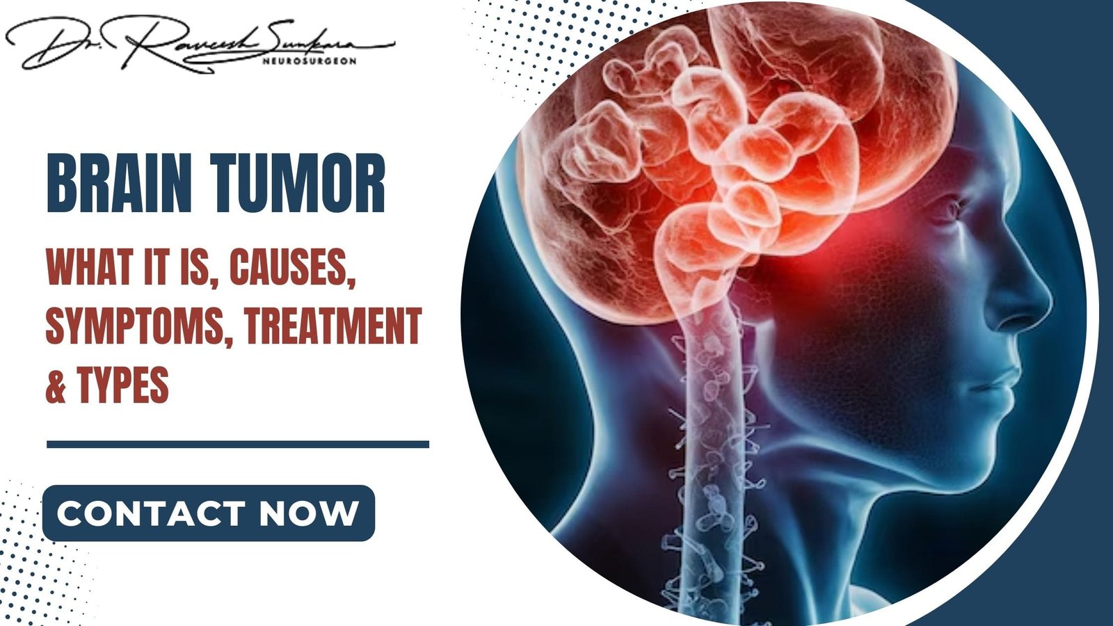 Brain Tumors Brain Tumors