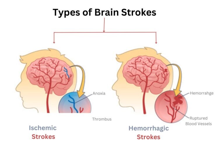 Types of Brain Strokes Types for brain stroke