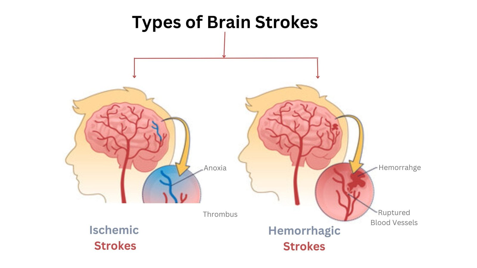 Types of Brain Strokes Types for brain stroke