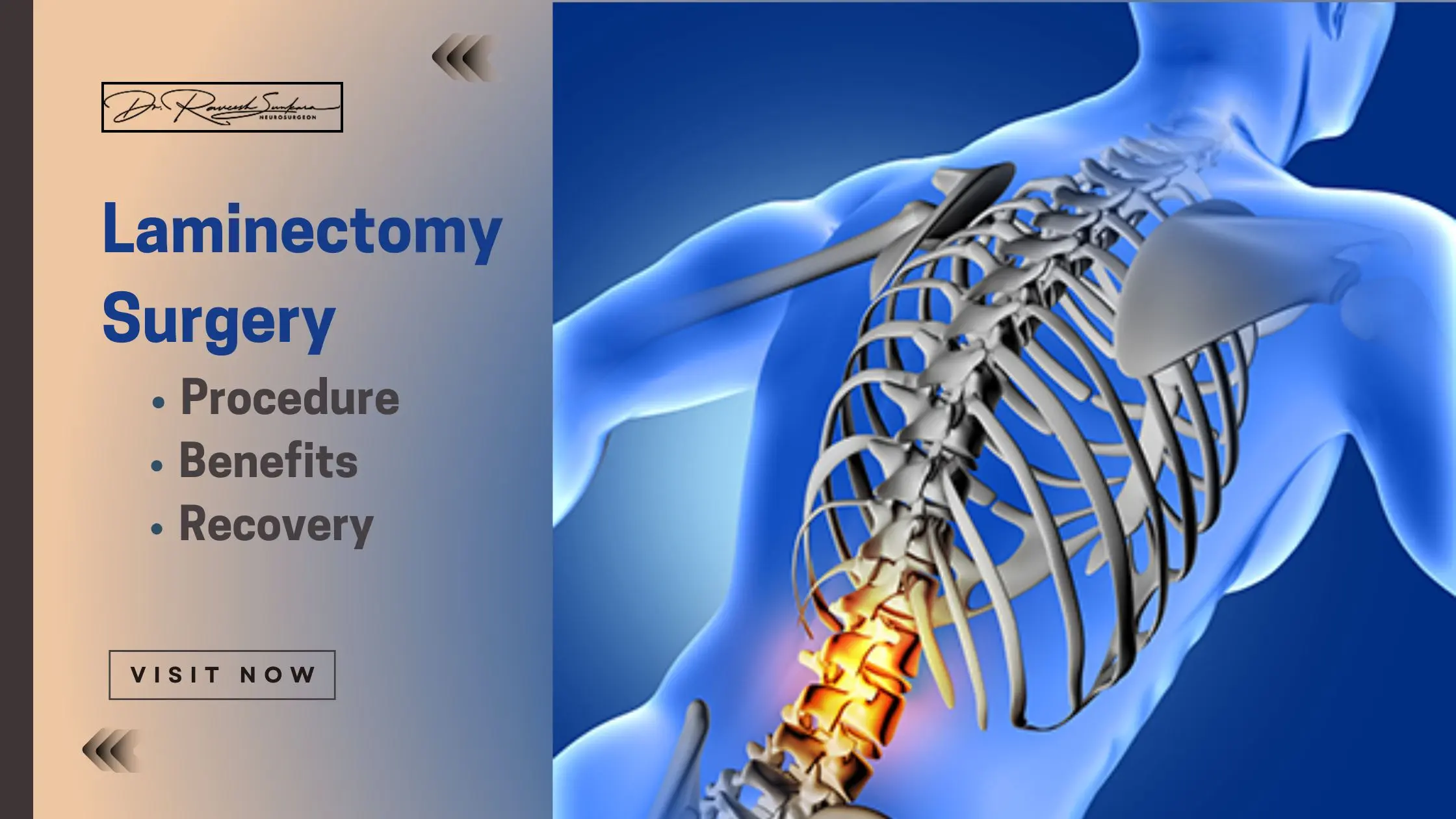 Laminectomy Surgery Laminectomy Surgery