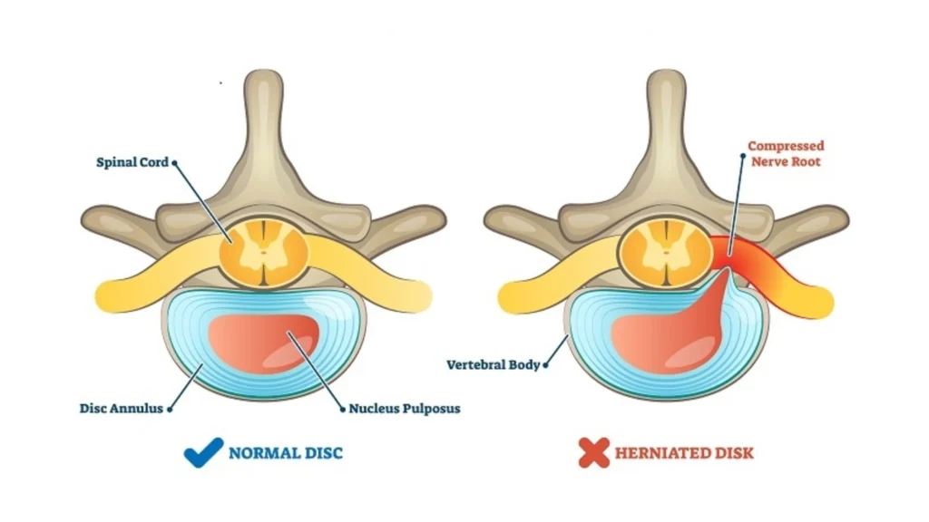 Herniated Disc