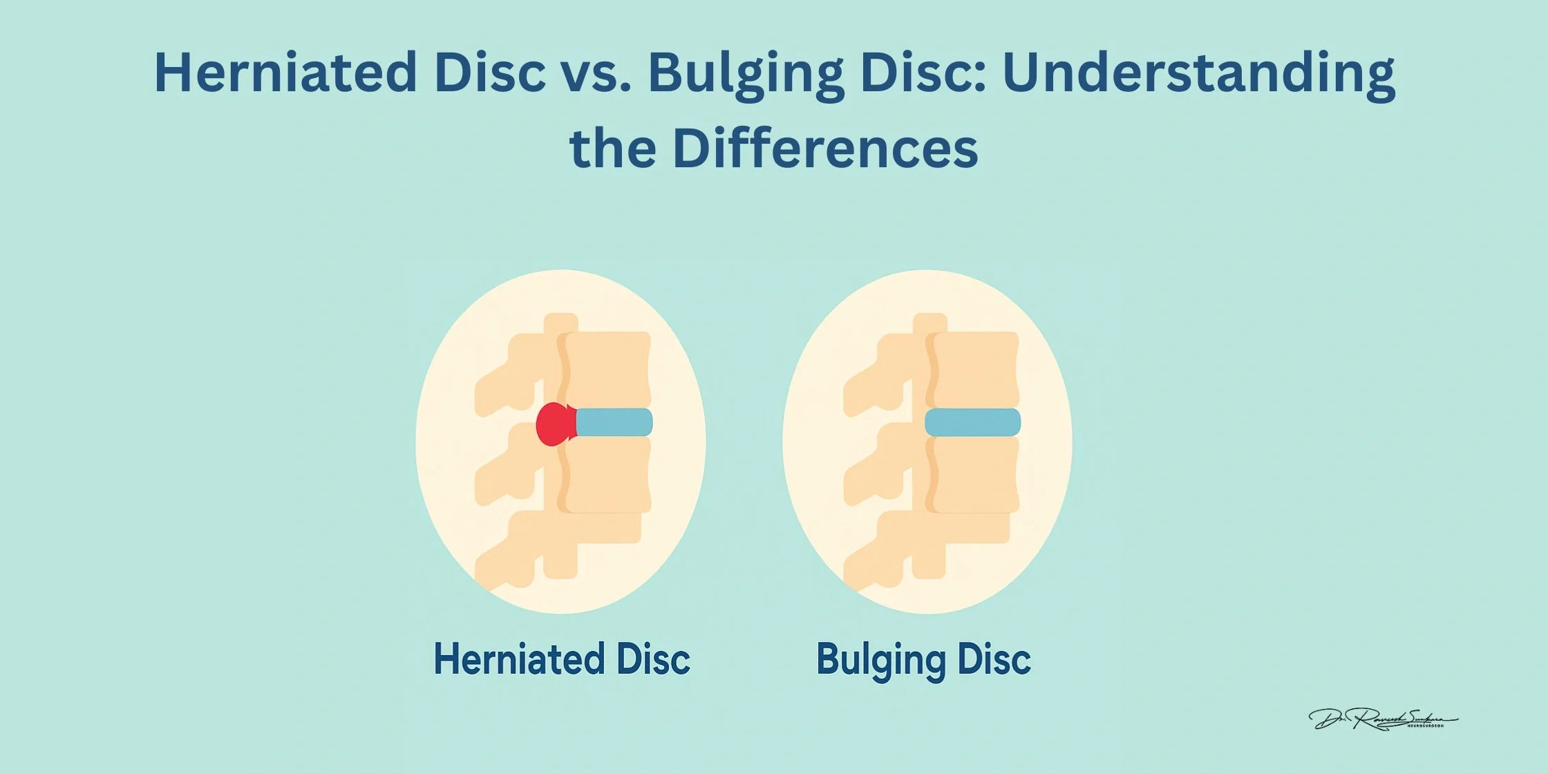 bulging vs herniated disc Herniated Disc vs Bulging Disc