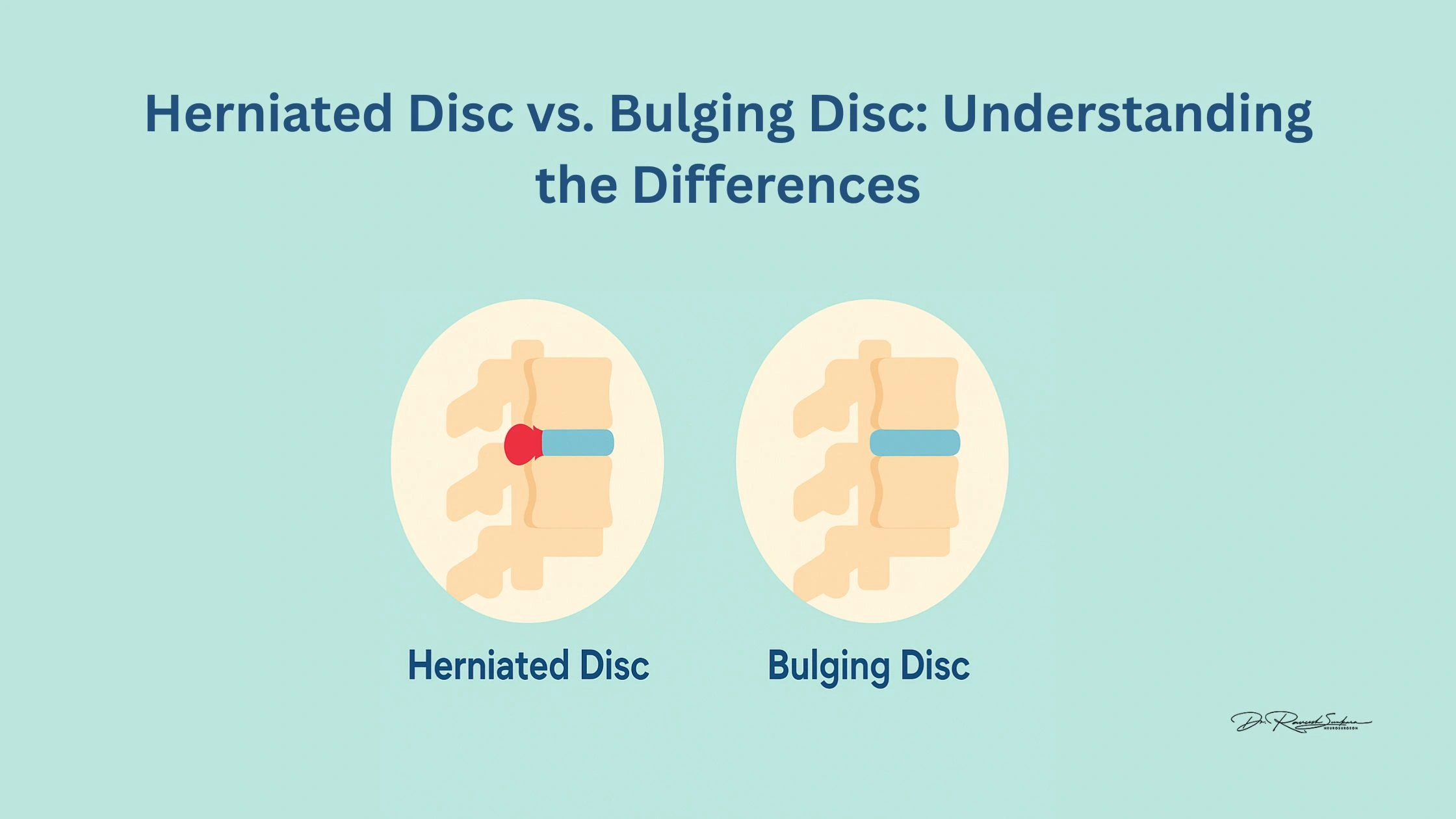 bulging vs herniated disc Herniated Disc vs Bulging Disc