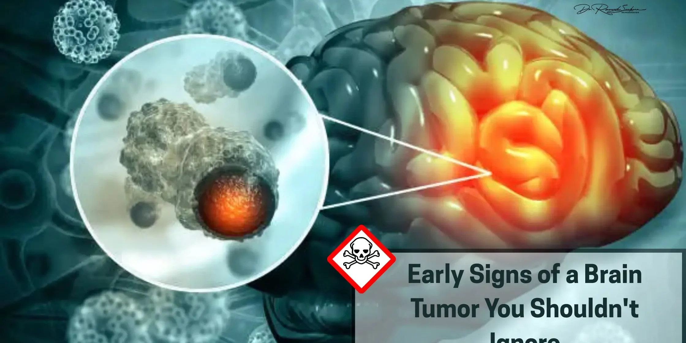 Early Signs of a Brain Tumor