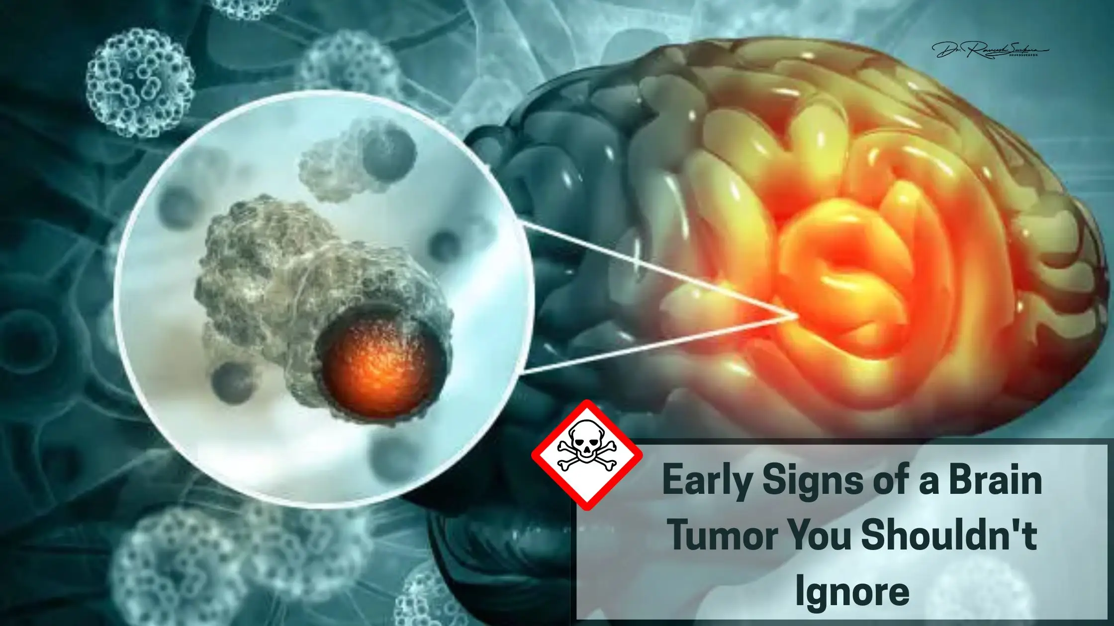 Early Signs of a Brain Tumor Early Signs of a Brain Tumor