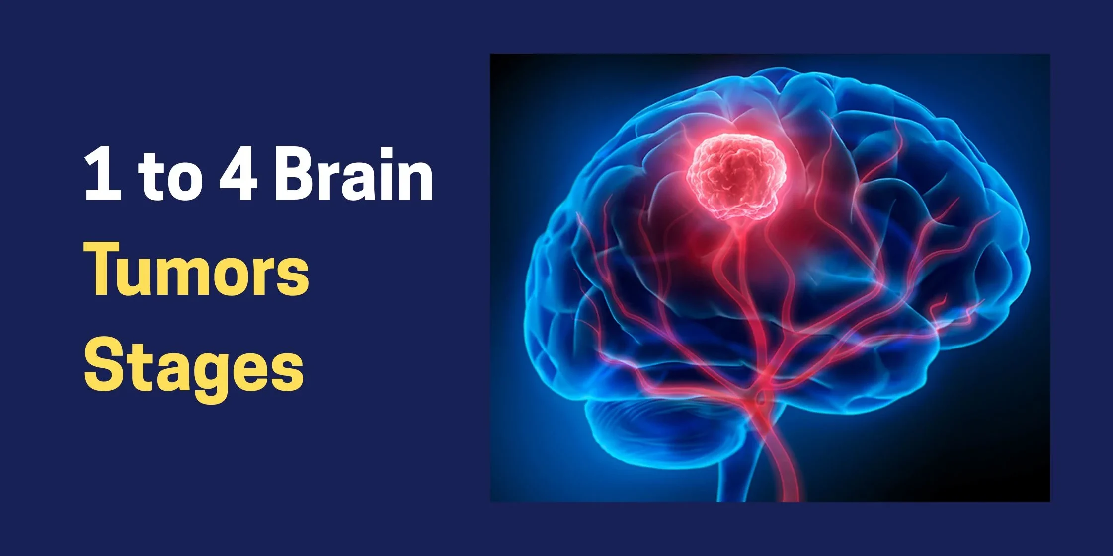 1 to 4 Brain Tumors Stages (1) Stage 1 to Stage 4 Brain Tumors