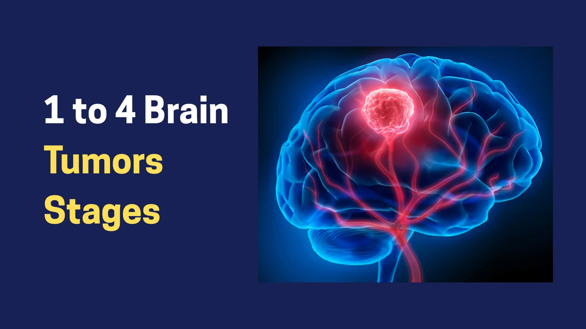 1 to 4 Brain Tumors Stages (1) Stage 1 to Stage 4 Brain Tumors