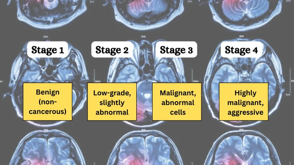 brain tumor stages