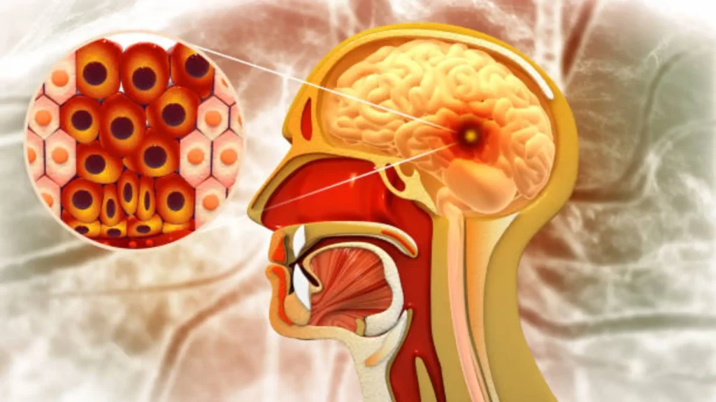 brain cancer stages