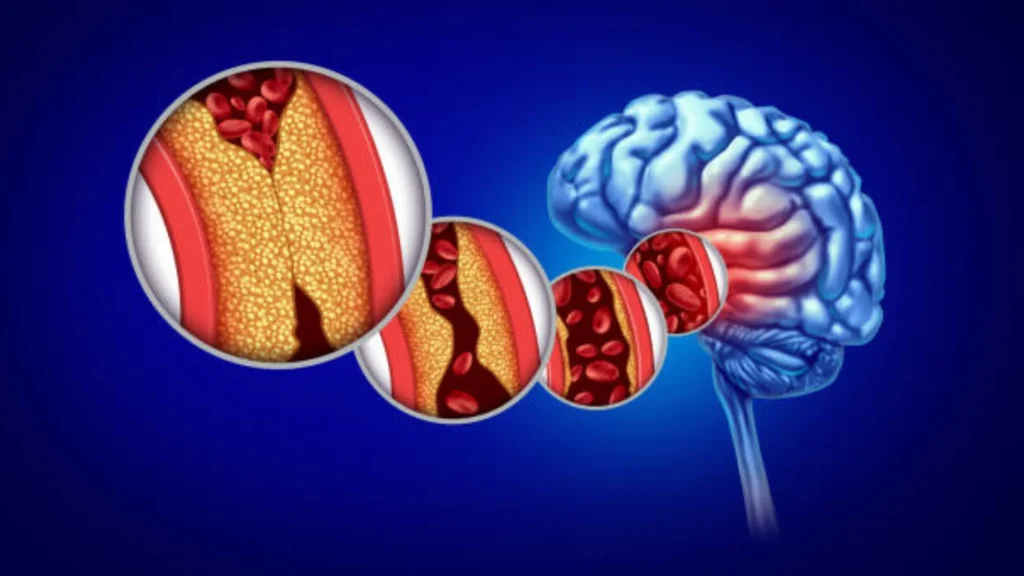 Blood Clot in Brain
