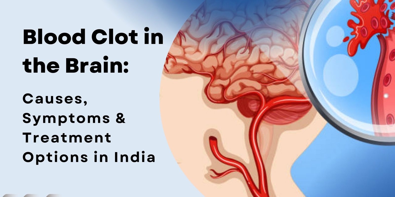 Blood Clot in the Brain