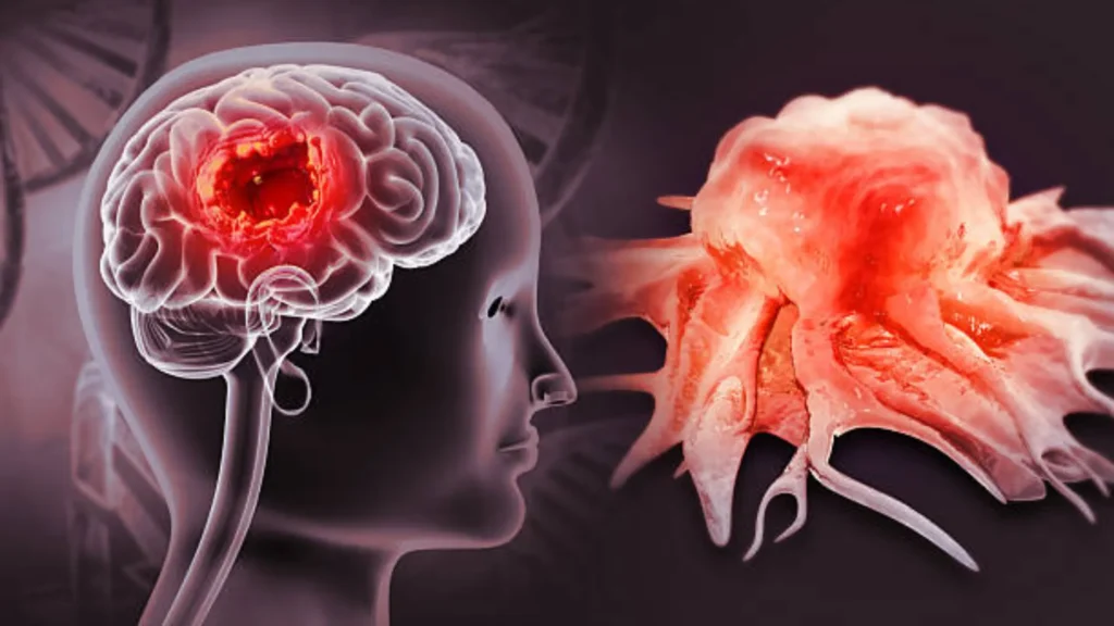 Brain Cancer Remain Undetected