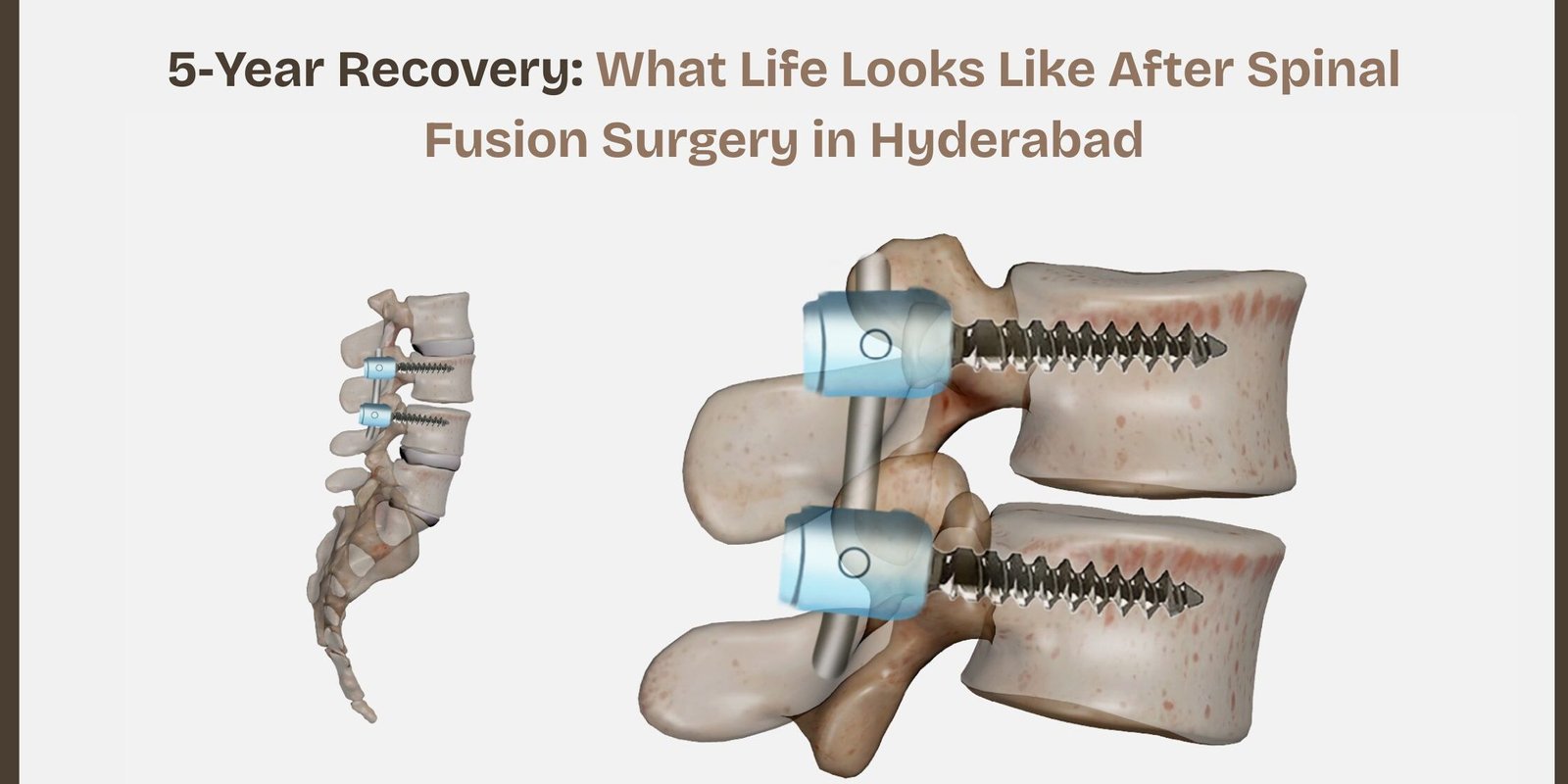 After Spinal Fusion Surgery