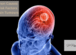 Common Causes and Risk Factors for Brain Tumours