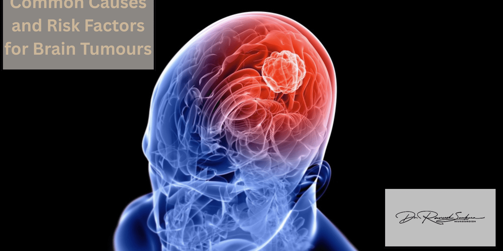 Common Causes and Risk Factors for Brain Tumours Common Causes and Risk Factors for Brain Tumours