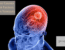 Common Causes and Risk Factors for Brain Tumours