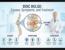 Disc Bulge Causes, Symptoms, and Treatment